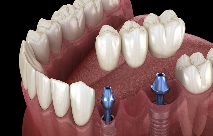 Dental Implants for Smokers: Is it a Good Option?