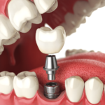 Dangers of Dental Implant Failure