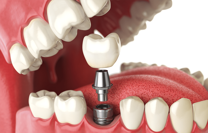 Dangers of Dental Implant Failure