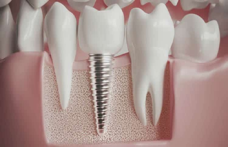 Check these insightful details about dental implants in Cotswold